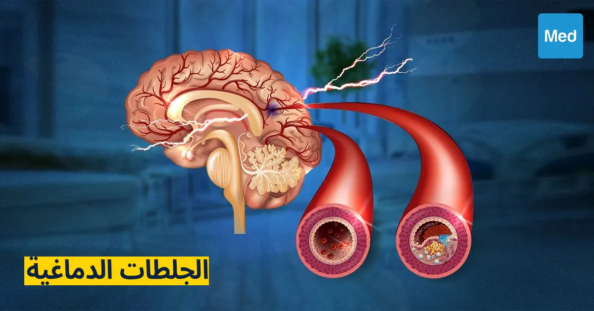 الجلطات الدماغية: الأسباب، الأعراض، التشخيص، والعلاج
